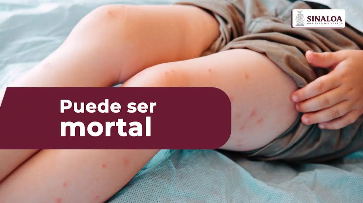 El sarampión es contagioso y mortal